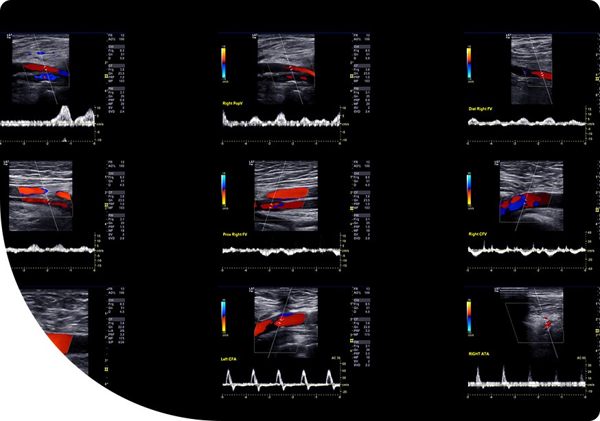 Colour doppler vascular ultrasound study
